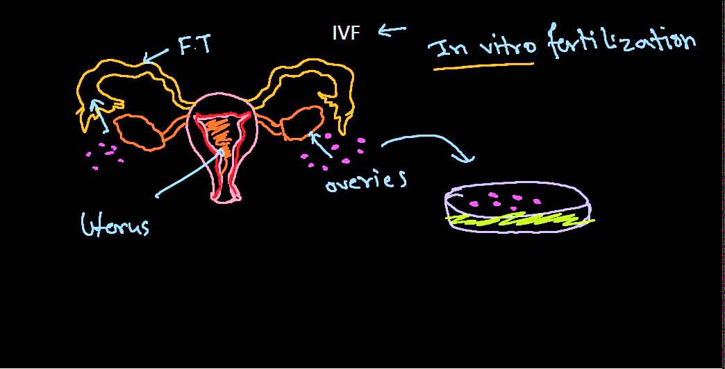 In vitro fertilization and embryo transfer (IVF procedure)