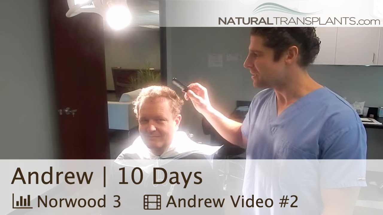 10 Day FUT [Strip Method] Hair Transplant Surgery Post-Op Follow-up, Natural Transplants (Andrew)
