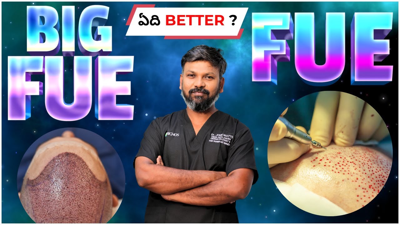 #AskDrJohnWatts | BIG FUE vs FUE ఏది BETTER ? | Hair Specialist Explains