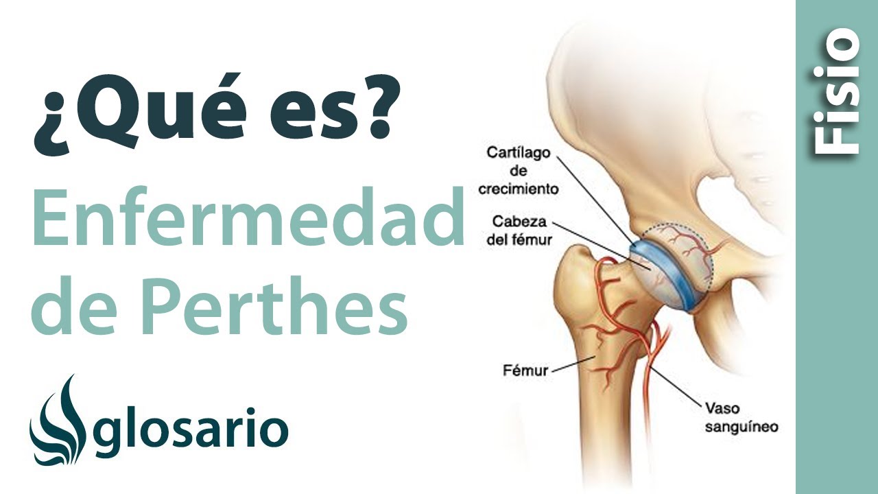 ENFERMEDAD DE PERTHES | &iquest;Qu&eacute; es?