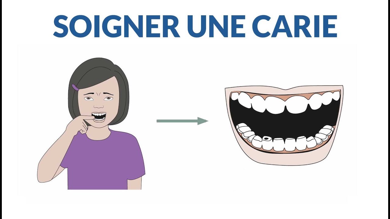 Comment soigner une dent cariée ?