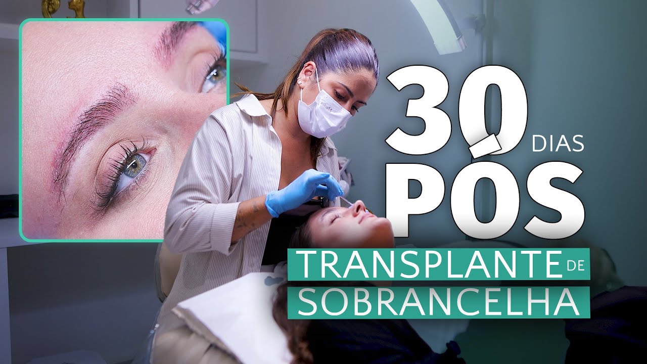 30 DIAS após TRANSPLANTE de SOBRANCELHA: acompanhe a EVOLUÇÃO da Manu? Original Brows Grupo Capilar