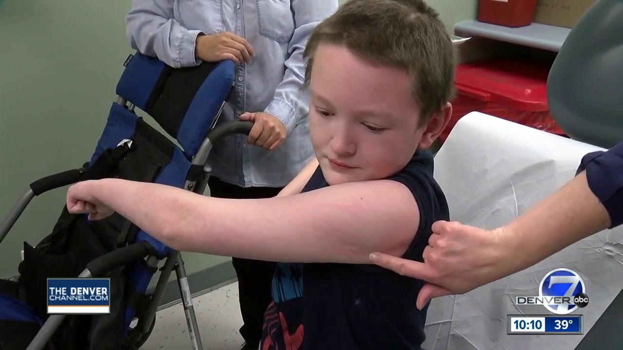 Alamosa boy's rare stiff skin condition worsening