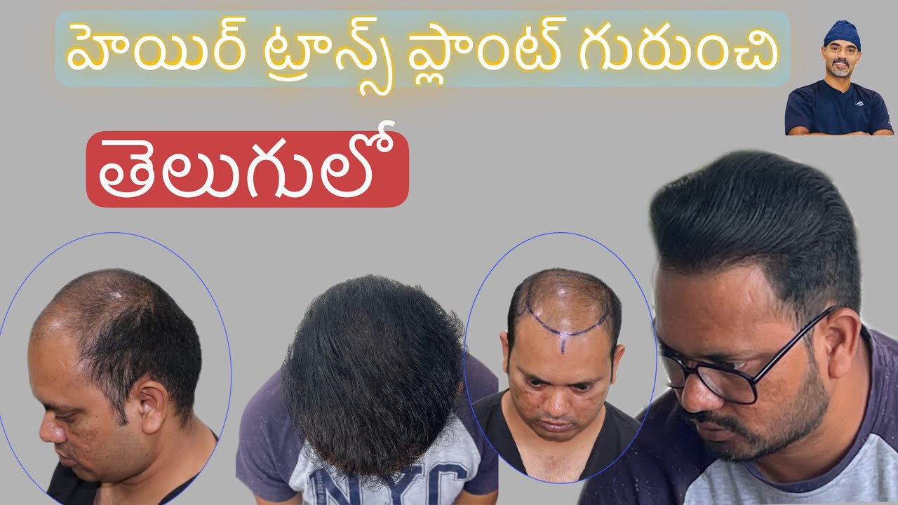 hair transplant vijayawad | Best Cost & Results hair transplant clinic in vijayawada.