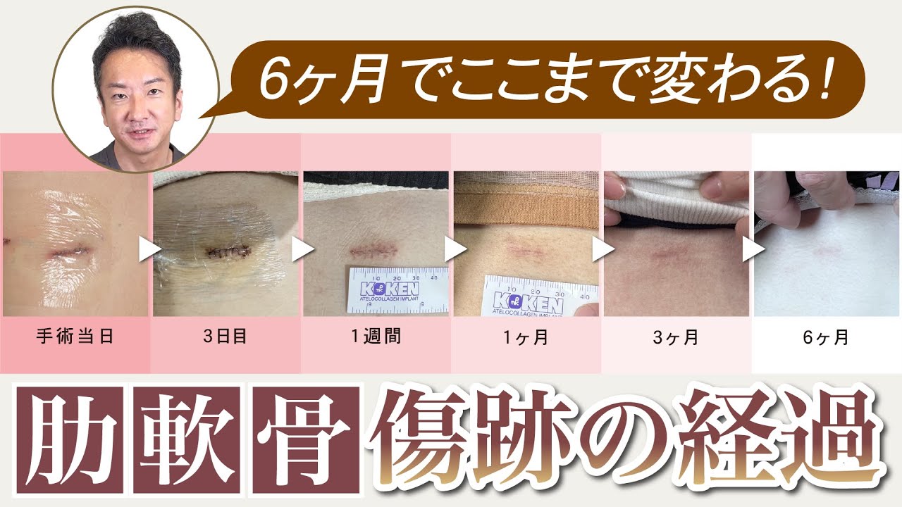 肋軟骨を採取した後の「傷跡の経過」ここまで変わる！