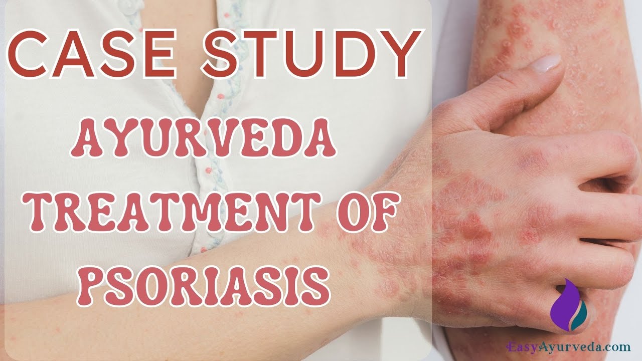 Case Study: Ayurveda Treatment of Psoriasis Only With Ayurveda Medicines And No Panchakarma
