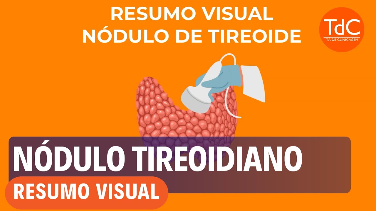 N&oacute;dulo Tireoidiano - Resum&atilde;o em 4 minutos