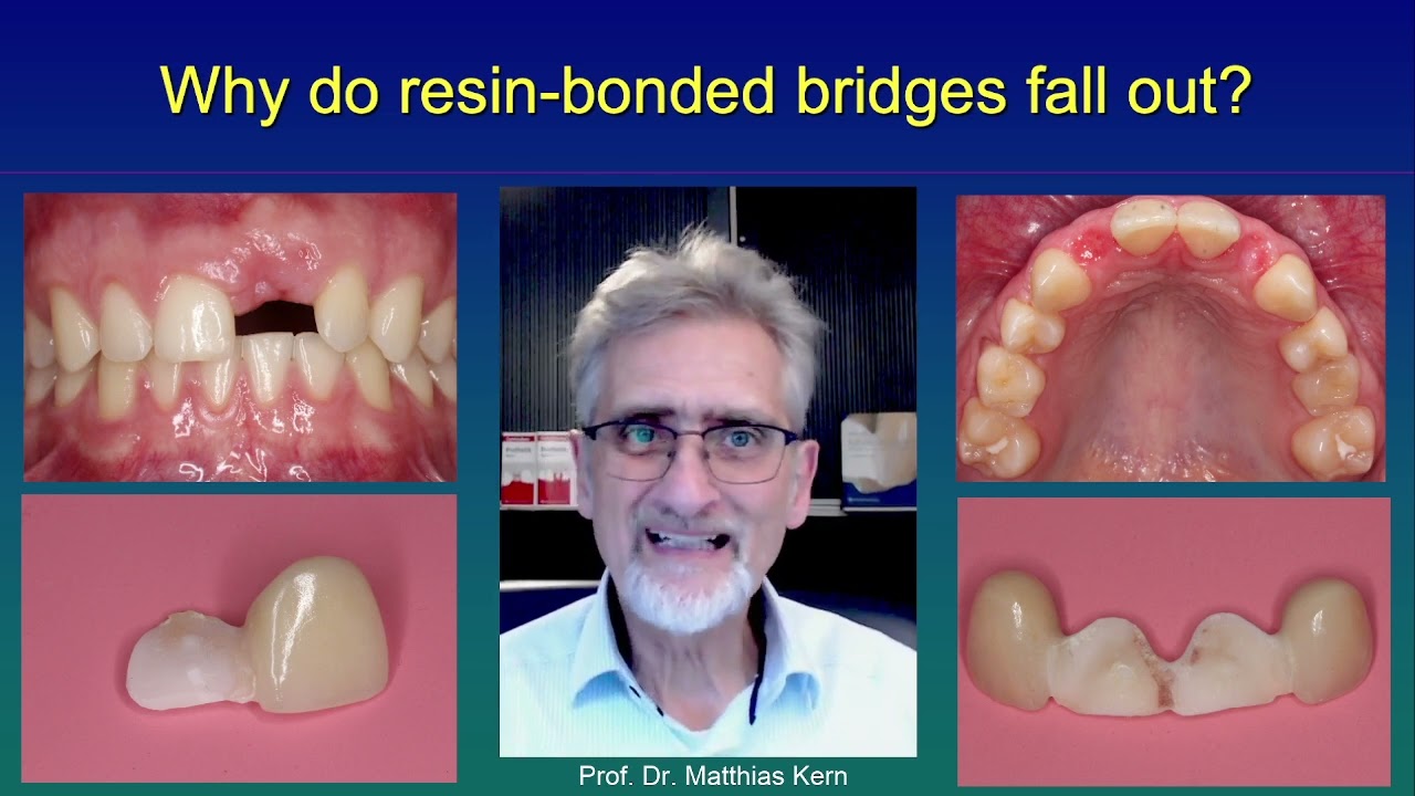Why do resin-bonded bridges fall out?