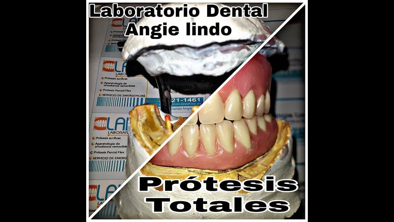 ENFILADO O ARTICULADO DE PRÓTESIS TOTALES, la inferior tiene implantes.