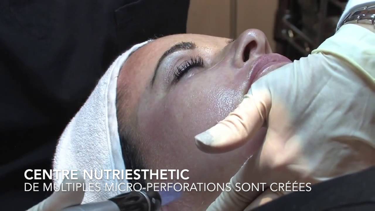 Microneedling du visage
