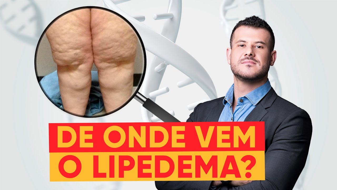 As causas do LIPEDEMA reveladas. | Dr. Felipe Balem