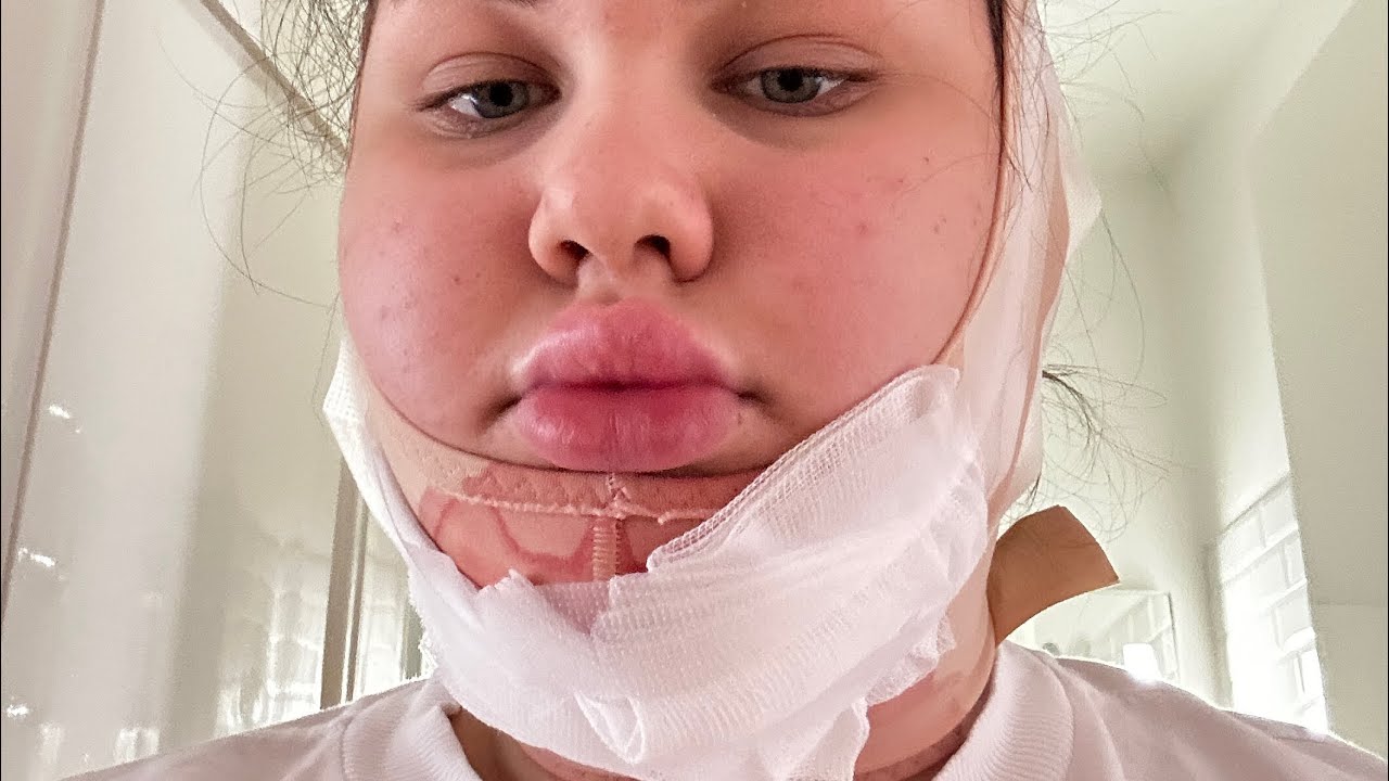 VLOG & all you wanted to know ohledně LIPOSUKCE | SugarDenny