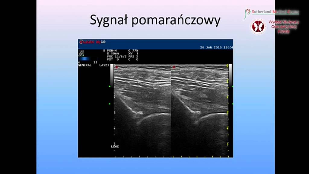 II Dzień Osteopaty #7 - Ultrasonograficzna diagnostyka r&oacute;żnicowa w praktyce osteopaty