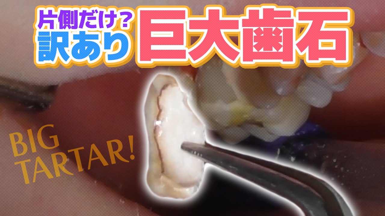 【歯石除去】片側だけ？訳あり巨大歯石‼️