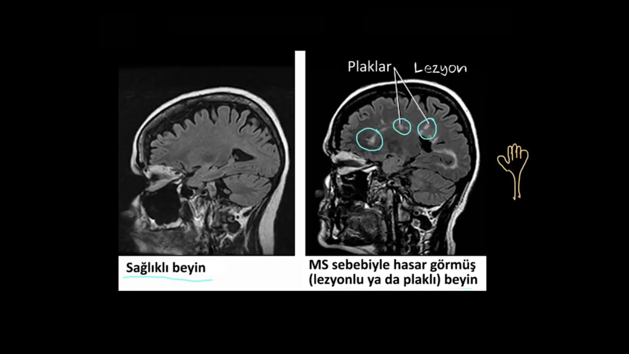 Multipl Skleroz (MS) Nedir? (Fen Bilimleri) (Sağlık ve Tıp)