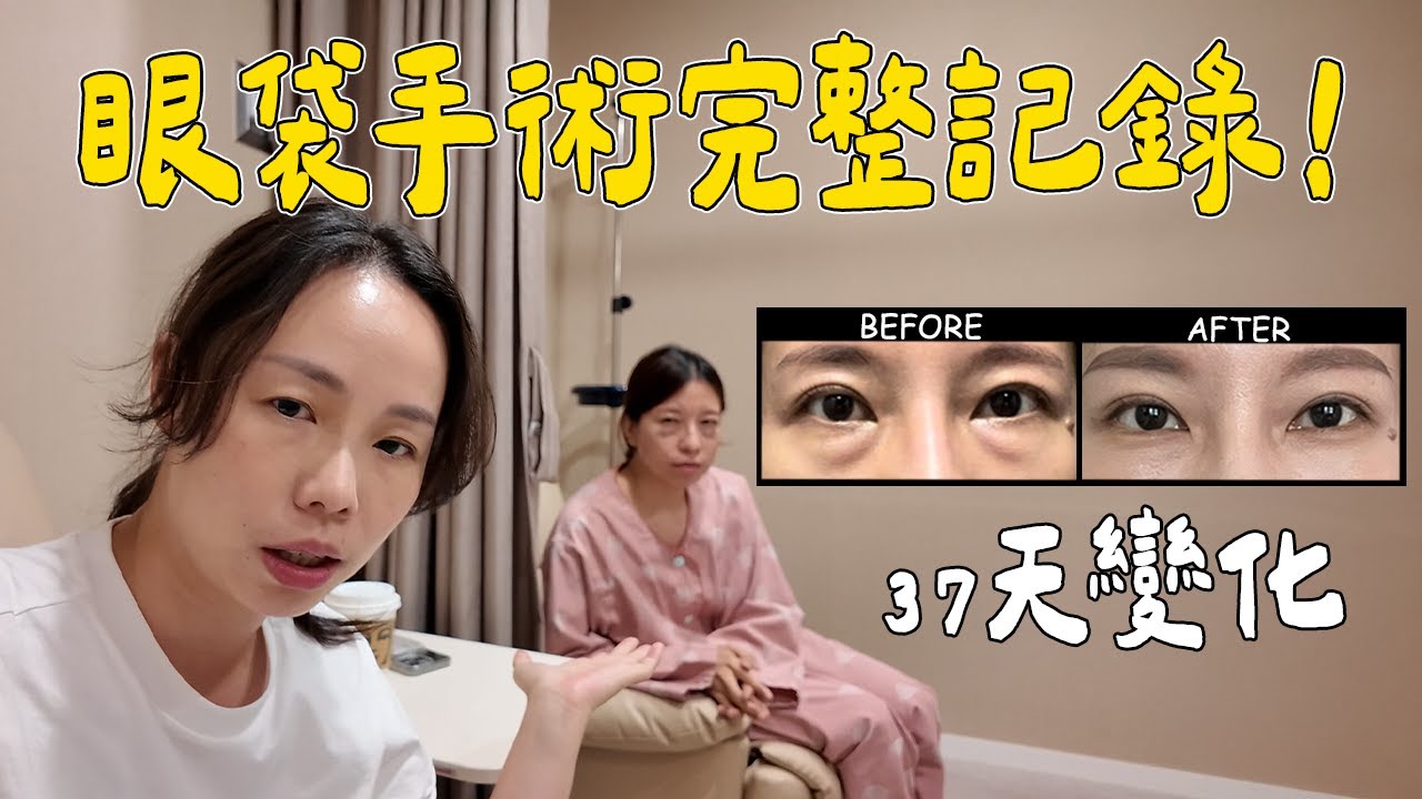眼袋手術大公開！詳細過程+37天恢復期全記錄！