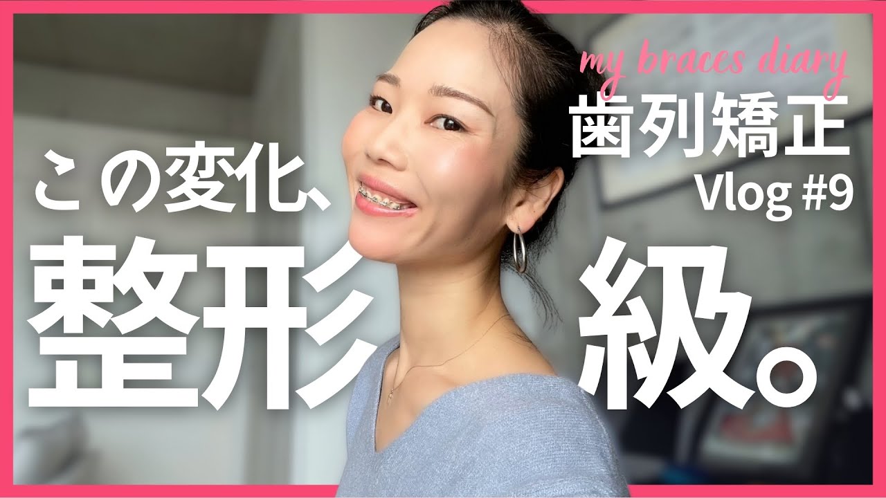 【歯列矯正】人中短くなった｜抜歯ワイヤー矯正の1年6カ月目｜ビフォーアフター写真公開