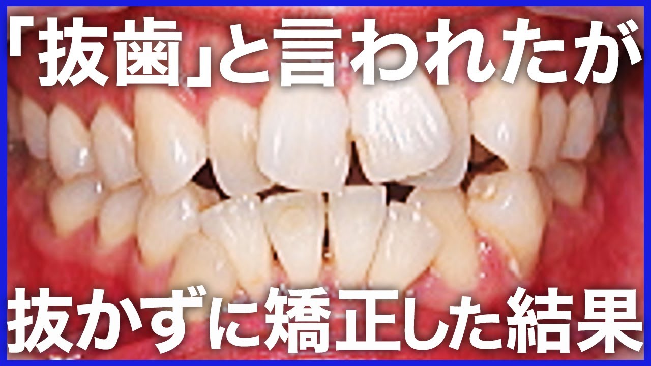 【ビフォーアフター】どこ行っても「抜歯」と言われた方を、抜かずに矯正した治療について解説します