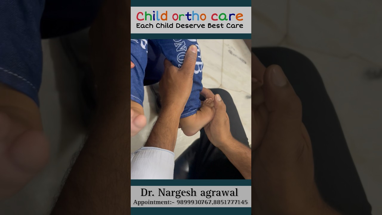 Clubfoot treated Without Tenotomy #clubfoottreatment #childorthocare #clubfoot