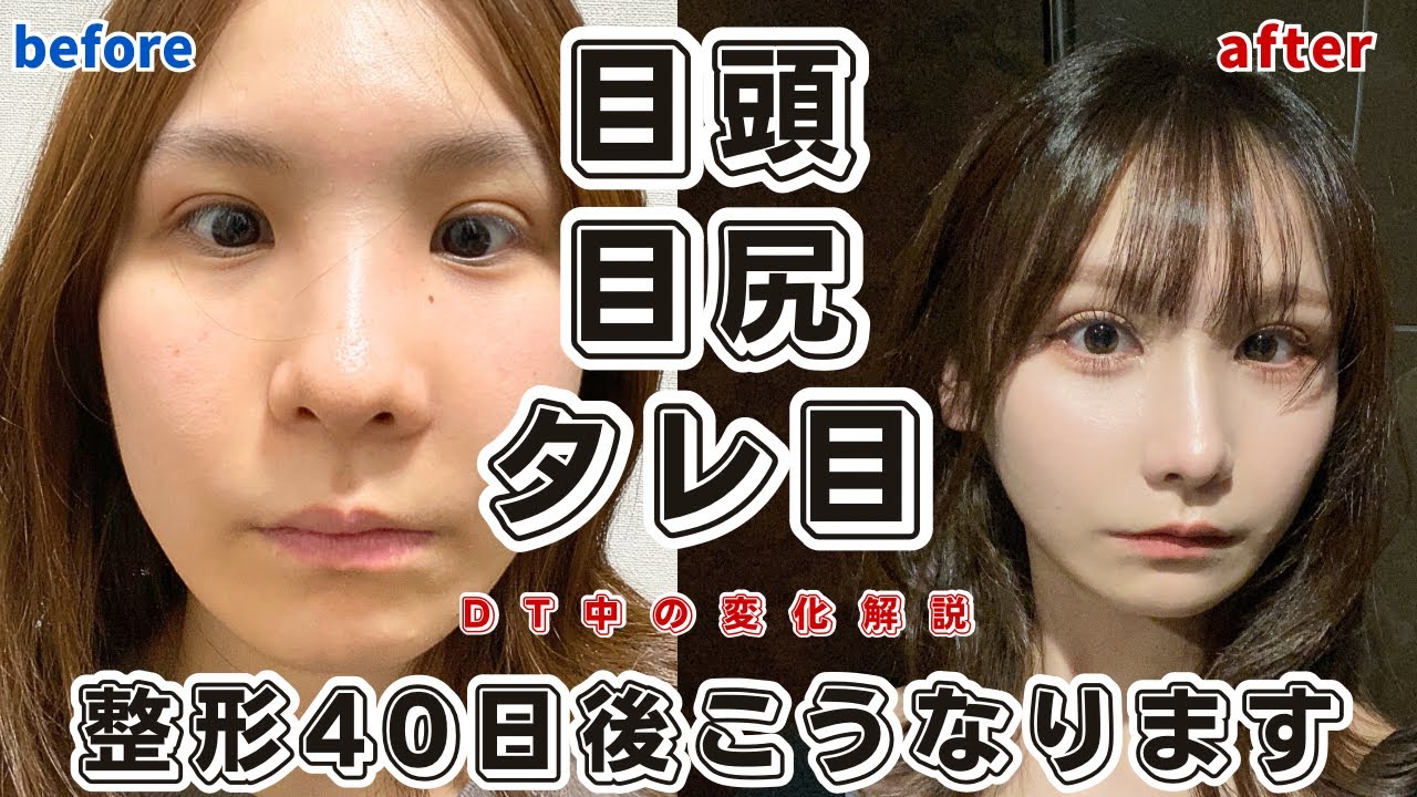 【整形】目頭切開・目尻切開・タレ目形成から40日！ダウンタイムの写真全公開して解説しよう！【奥目／蒙古襞強め】