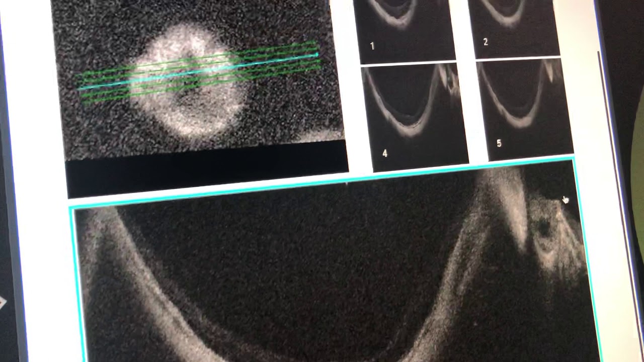 The ocular fundus (the back of the eye) of a highly nearsighted patient