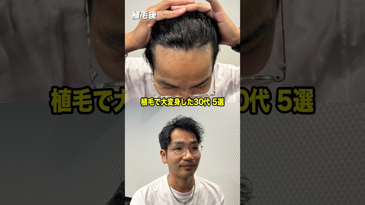 植毛して男前になった30代男性 5選 #shorts