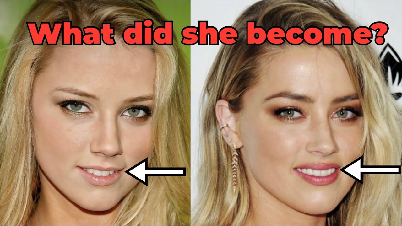 Amber Heard  Before and After #shorts #plasticsurgery