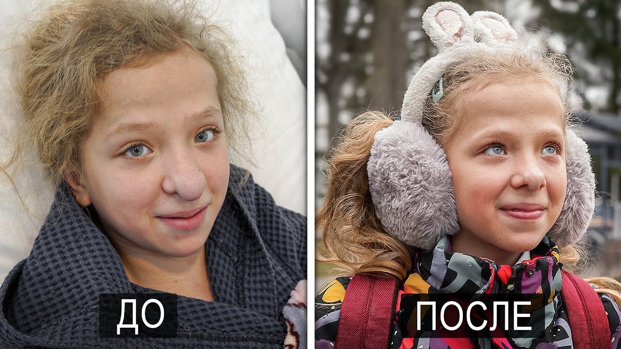 Новый носик-новая жизнь.Но не всё как мы ожидали.