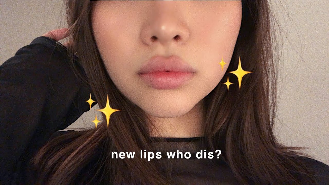 💖Trying Lip Fillers for the First Time!! @ LaserAway