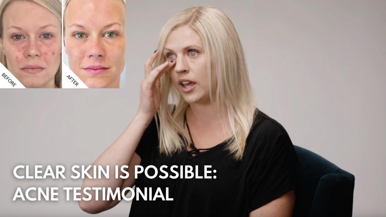 Sarah Hamilton FACE Acne Testimonial