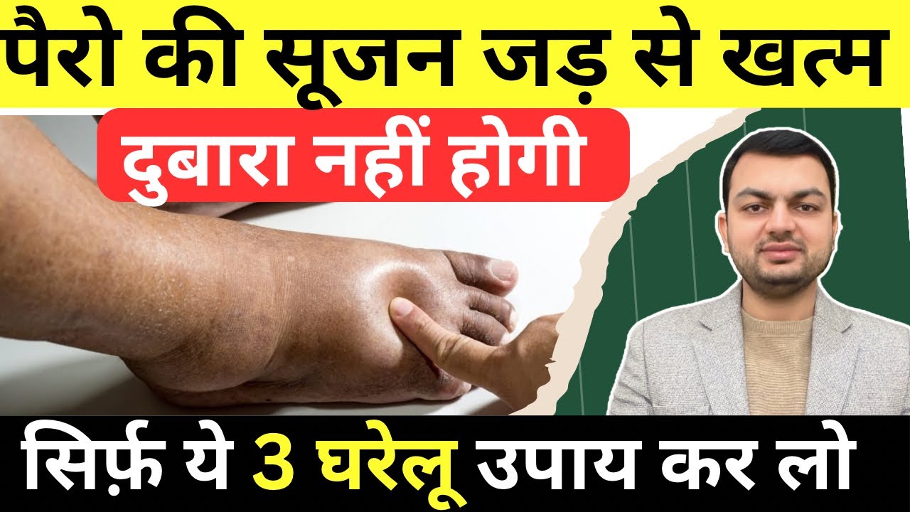 पैरों में सूजन के 3 असरदार घरेलू उपाय | Paeron Me Sujan। Swelling In Legs Home Remedy@DrRahulRathee 