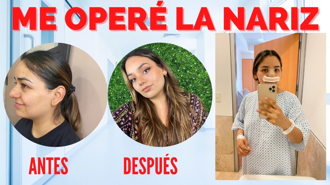 🤕 ME HICE LA RINOPLASTÍA 🤕