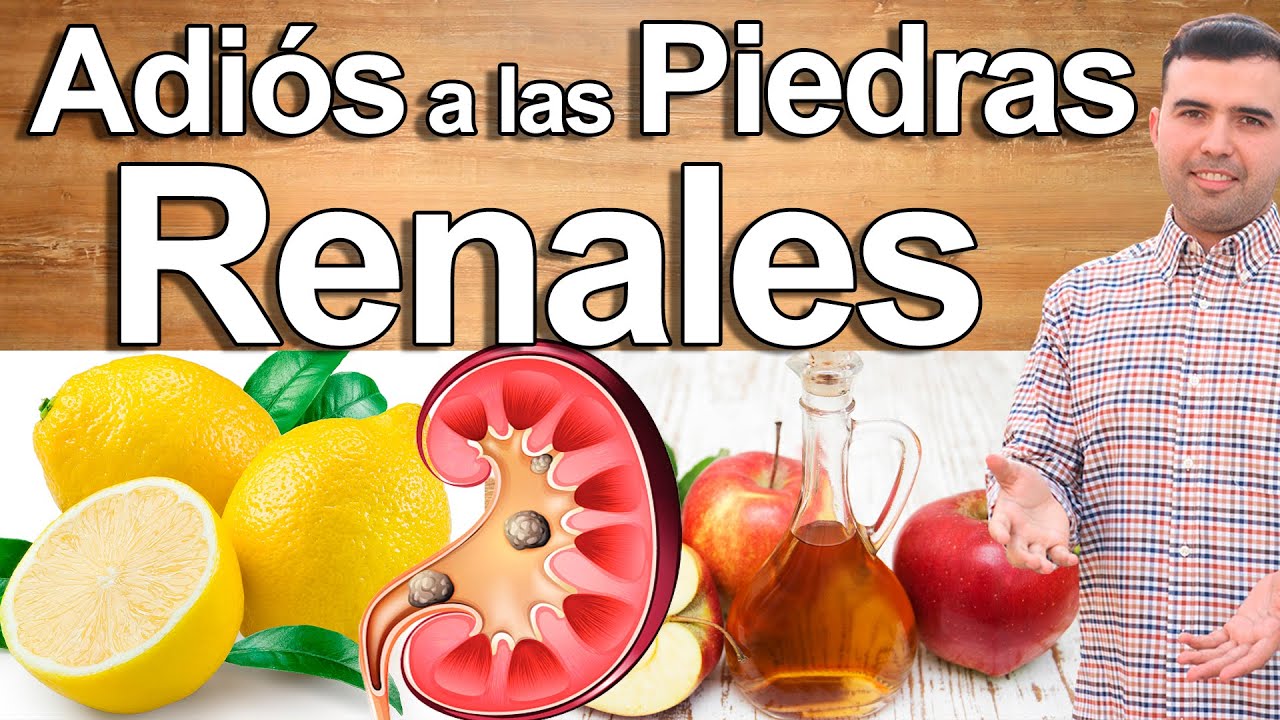 Como Eliminar Piedras o Calculos Renales - Piedras en Los Riñones Nunca Más