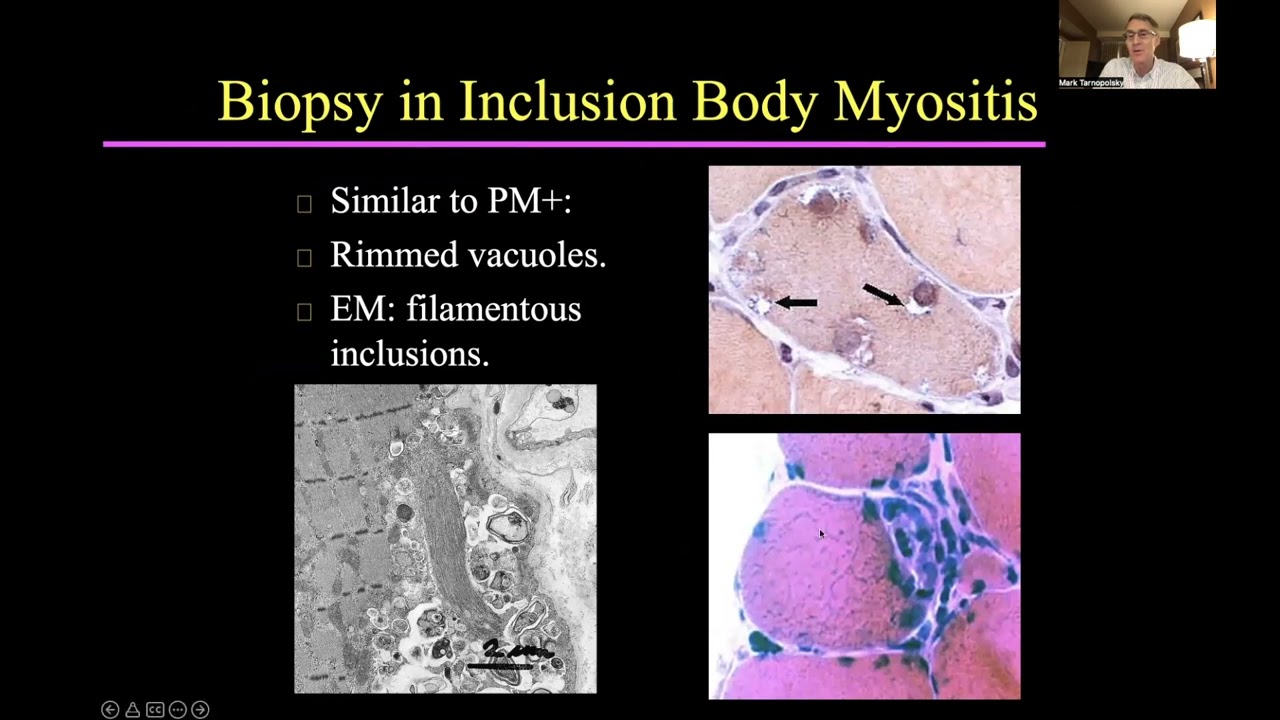 Exercise and Nutritional Interventions for Patients Suffering from Inclusion Body Myositis - Part 1