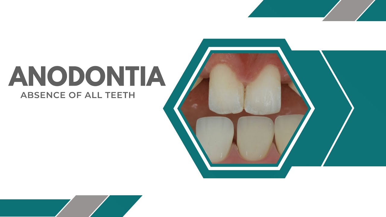 Anodontia: Absence of All Teeth - Causes, Symptoms, and Treatment