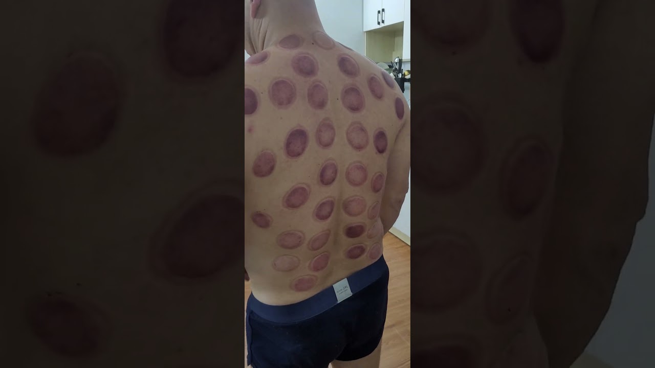 Cạo Gi&oacute; Gi&aacute;c Hơi Tại Nh&agrave; - Massage Thư Gi&atilde;n Quận 4 TPHCM