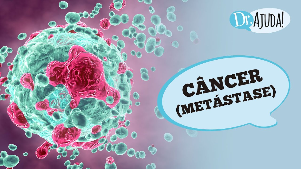 MET&Aacute;STASE DO C&Acirc;NCER: O QUE &Eacute;, DIAGN&Oacute;STICO E TRATAMENTO