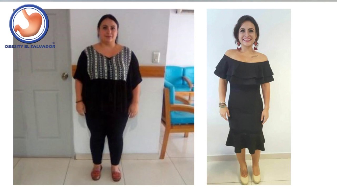 TESTIMONIO 1 AÑO DESPUES DE BYPASS GASTRICO EN EL SALVADOR