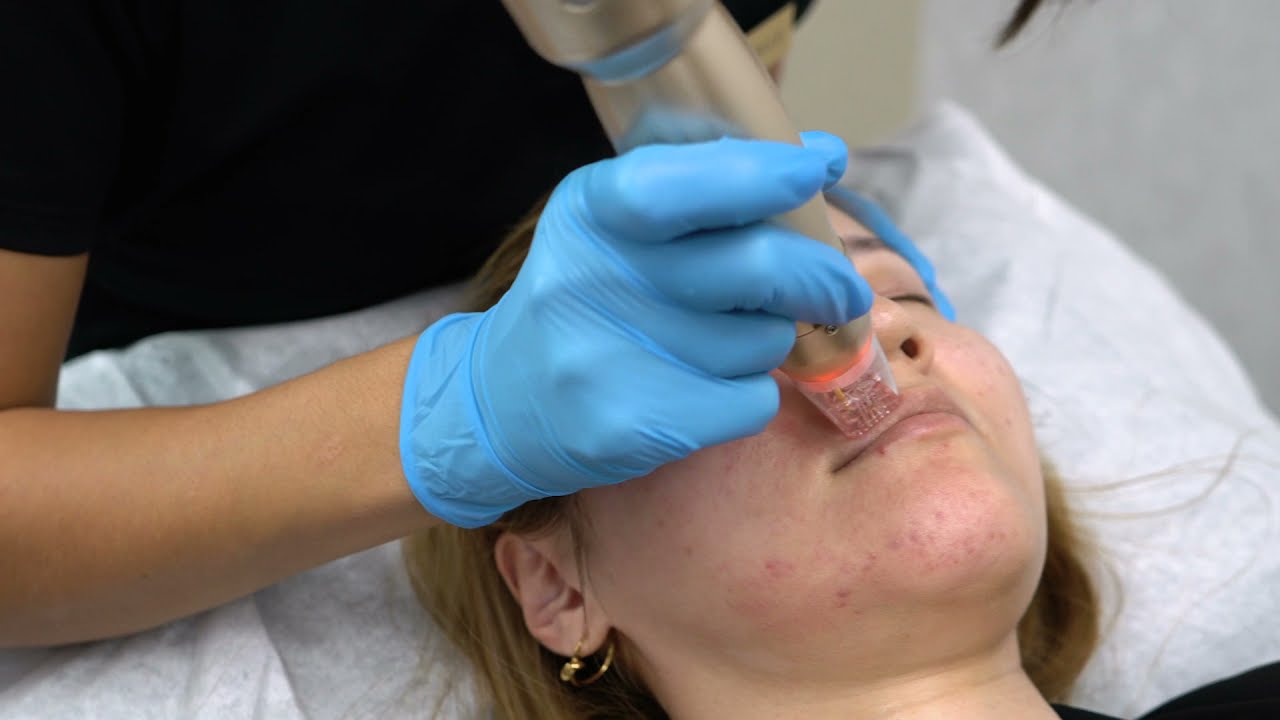 The #1 most requested treatment to date | Sylfirm X