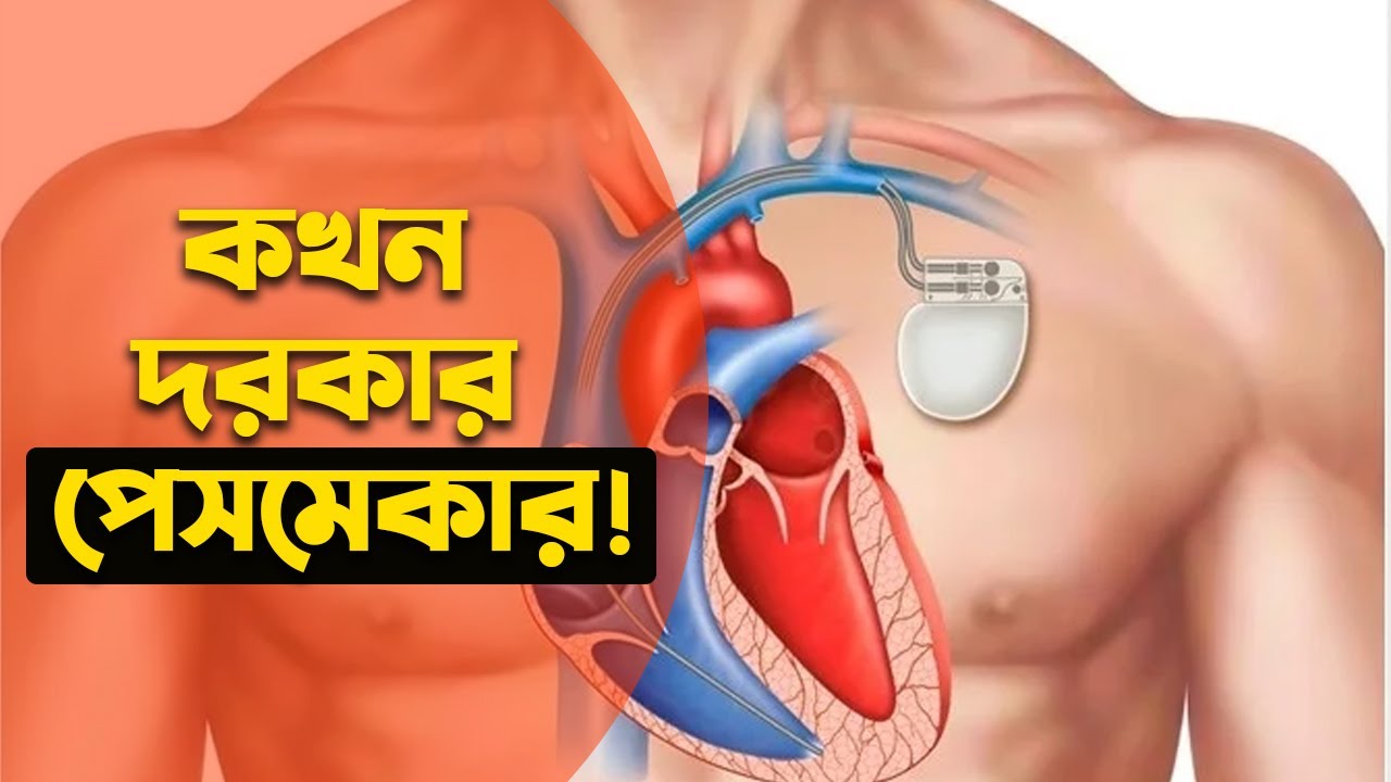 পেসমেকার কি, পেসমেকার কিভাবে কাজ করে এবং কখন বসানো হয়। know about Pacemaker! -Rog Balai