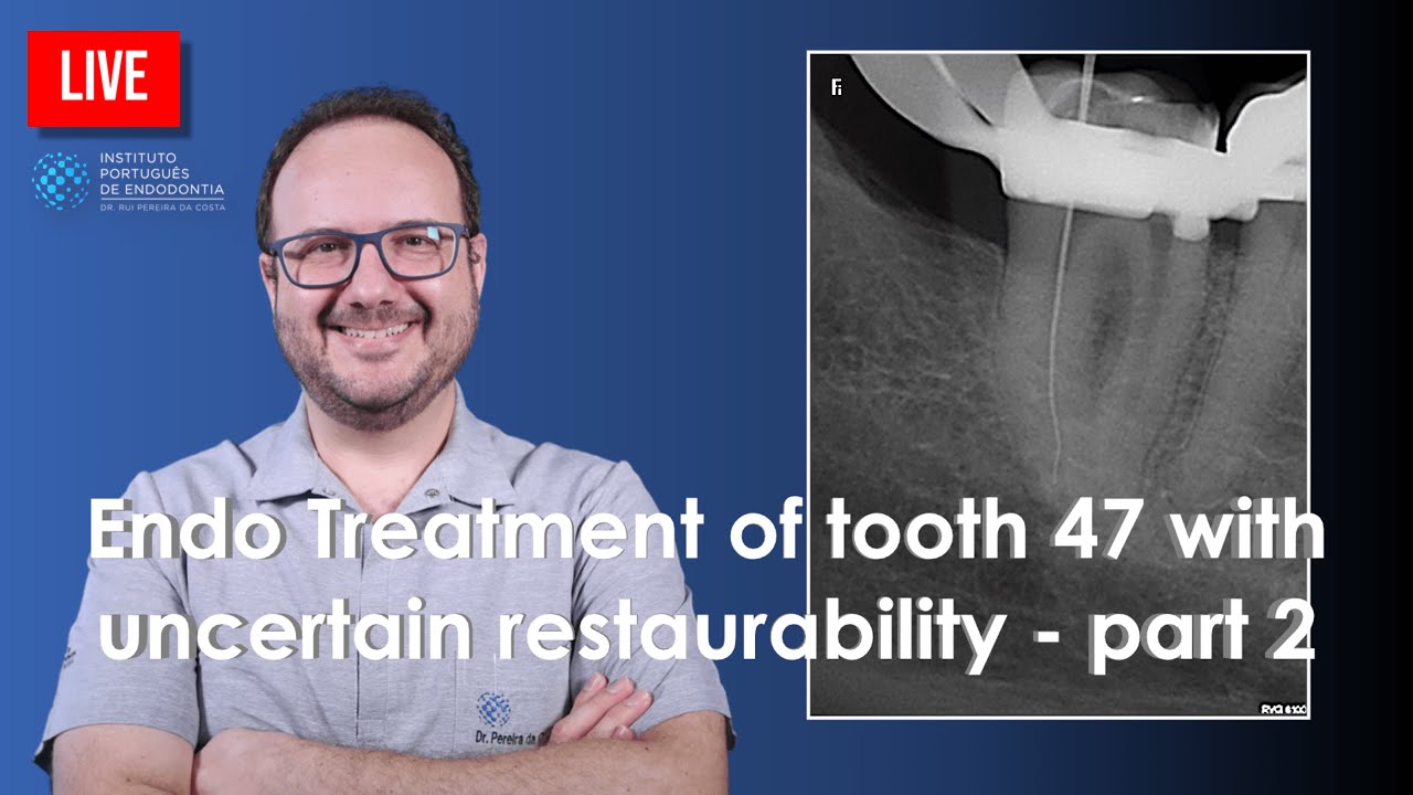 🔴 Endo Treatment of tooth 47 with uncertain restaurability - part 2