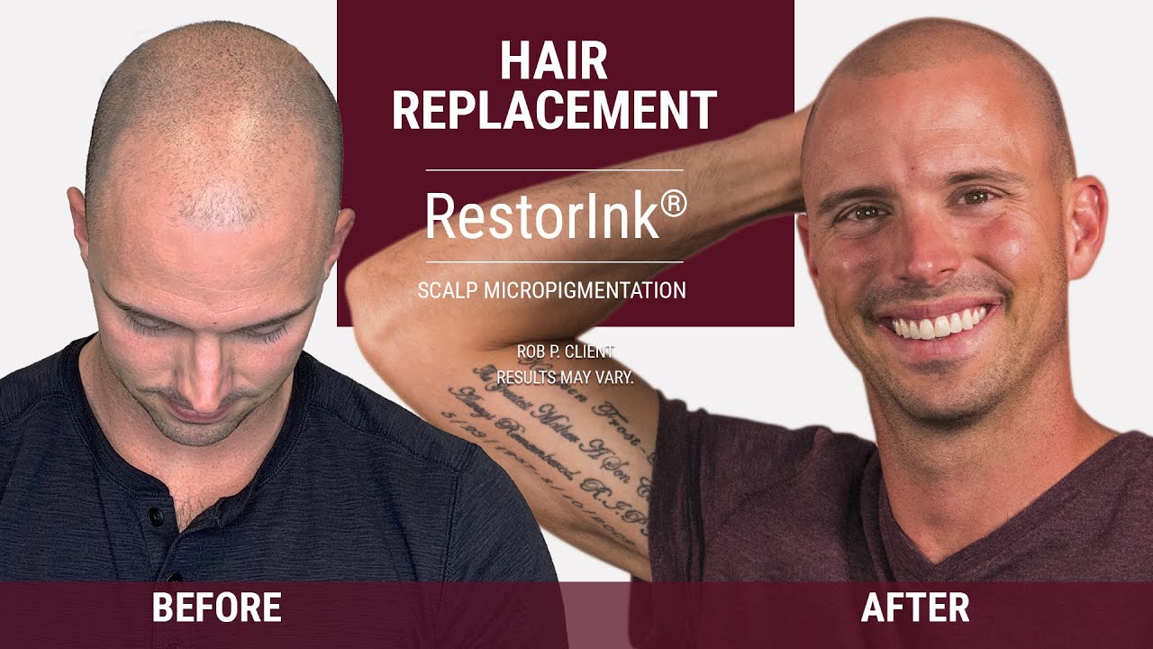 RestorInk Scalp Micropigmentation Results with Rob P. (Firefighter)