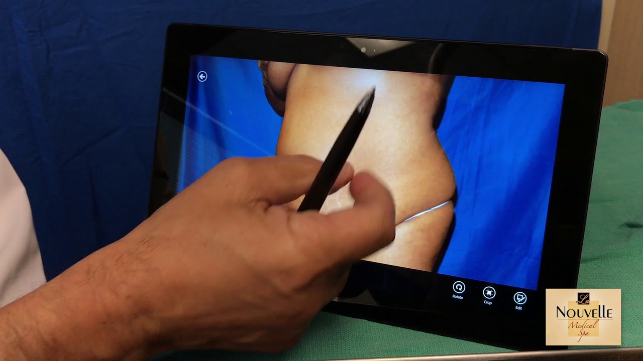 Abdominoplasty or Tummy Tuck - What the procedure Achieves | Dr. Hanna, Oxnard