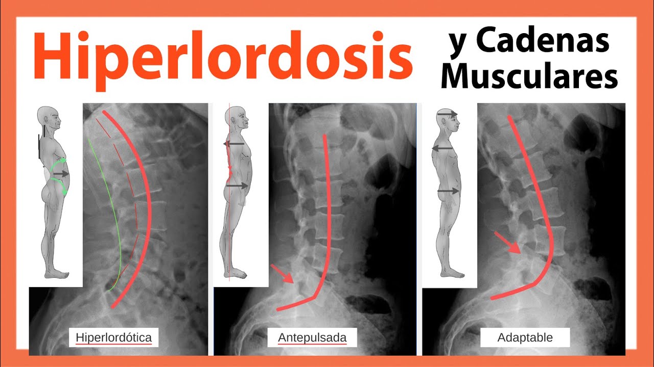 🔴 HIPERLORDOSIS y Cadenas Musculares (Lumbago y Artrosis) 👉 Son Claves el Diafragma y el Psoas