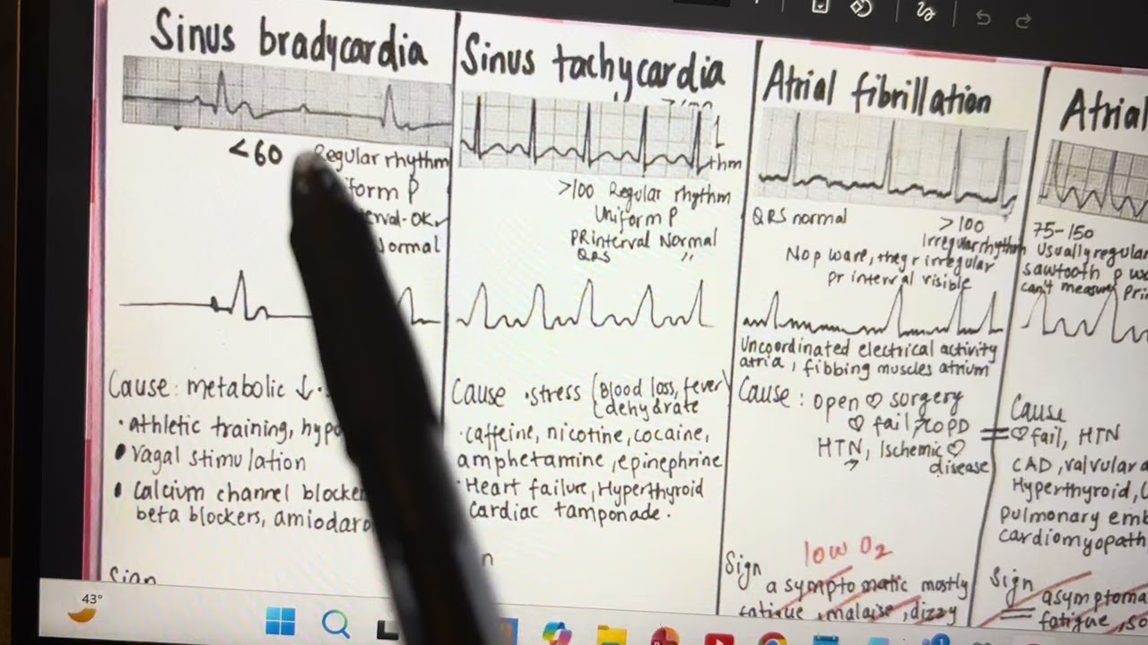 Sinus bradycardia and sinus tachycardia 