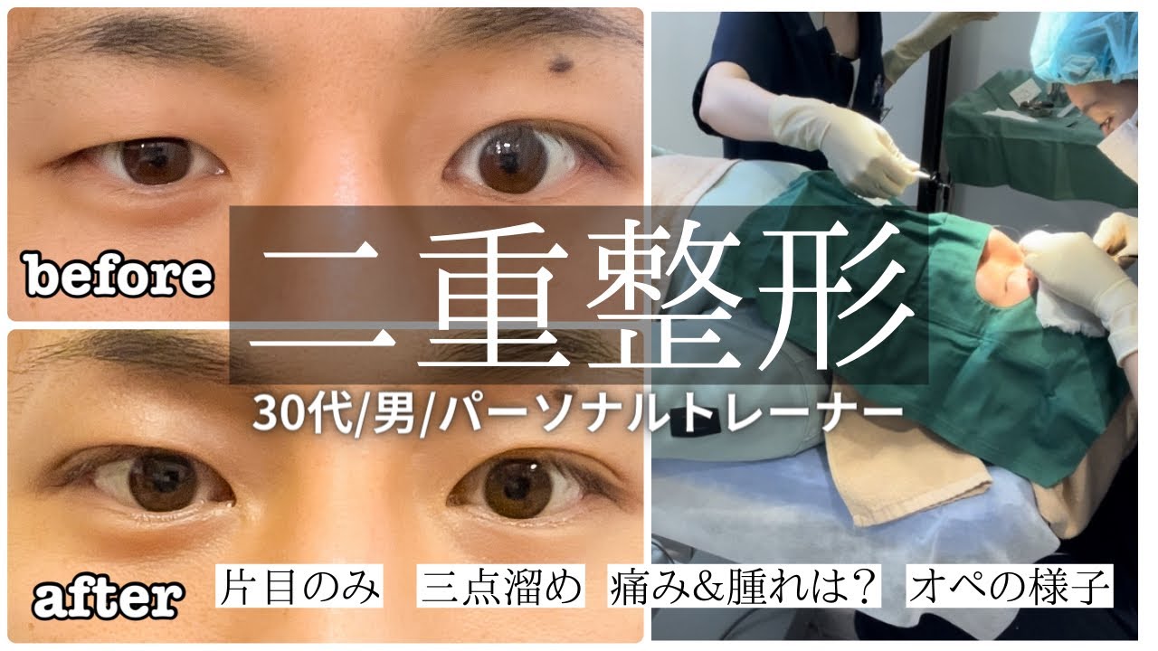 【二重埋没】完全密着!!オペ中の様子も大公開!!【三点留め/左右非対称】