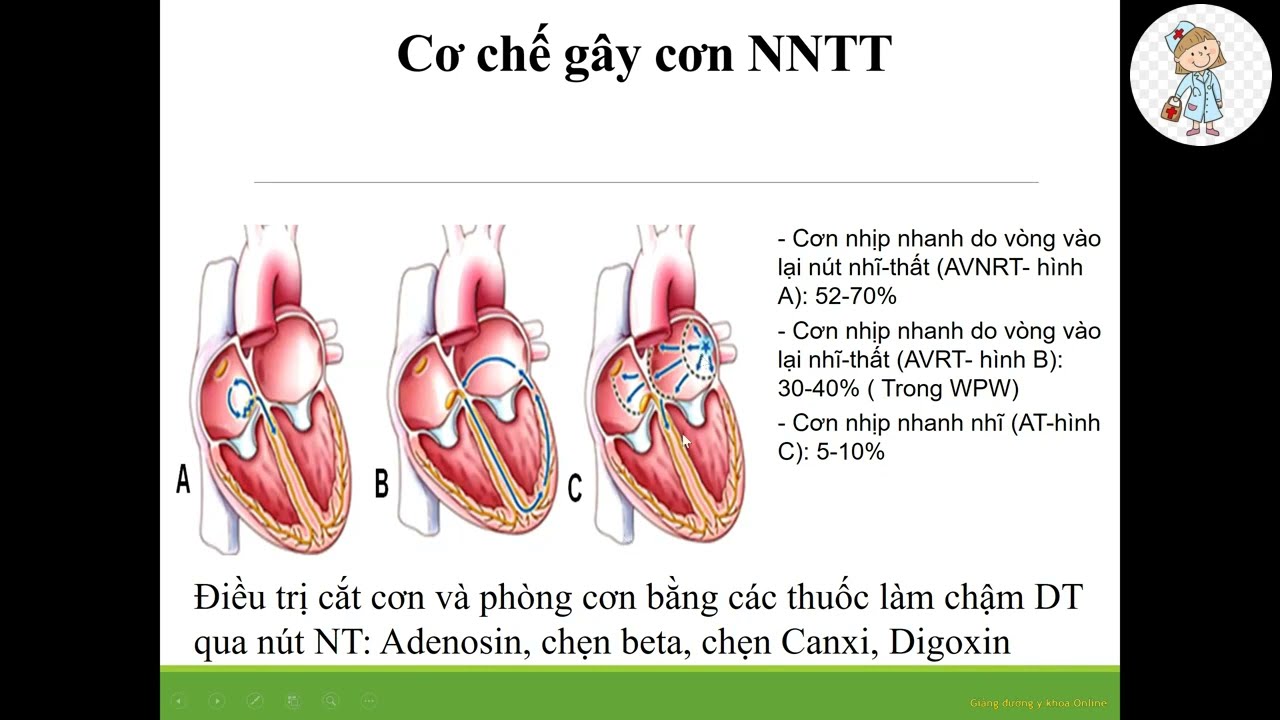 ĐIỆN TÂM ĐỒ TRONG CHẨN ĐOÁN CƠN NHỊP NHANH KỊCH PHÁT TRÊN THẤT | TS. BS. Trần Song Giang