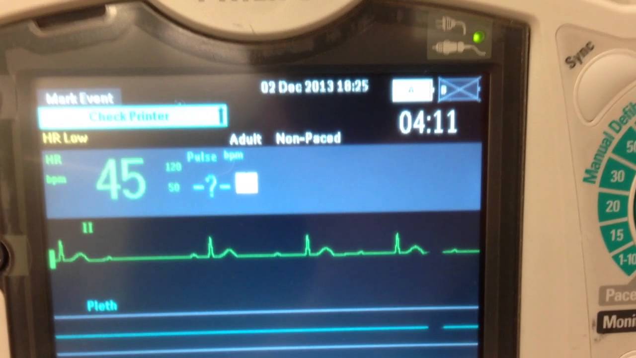 Second degree versus third degree heart blocks