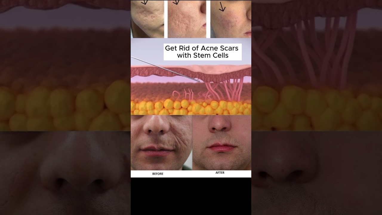 Say Goodbye to Acne Scars with Stem Cell Therapy! 🌿✨