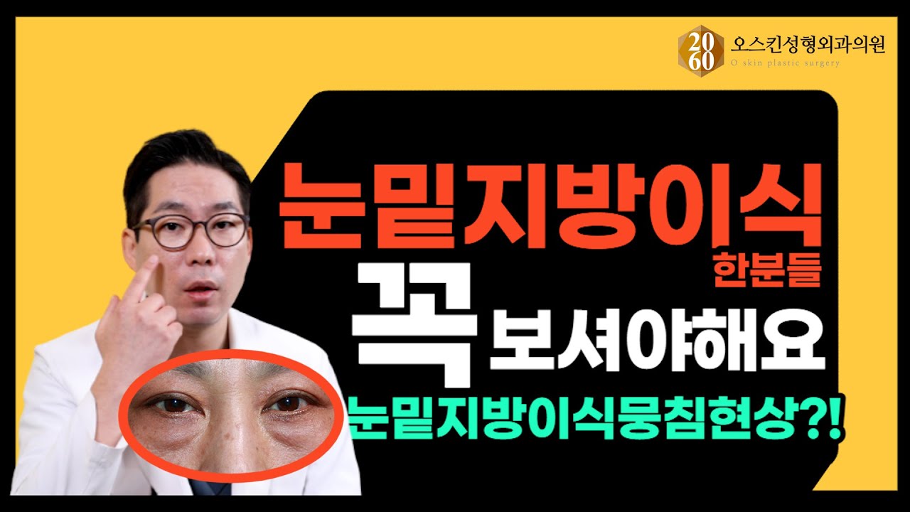 눈밑지방이식 하셨다면 꼭 보세요(뭉침현상)